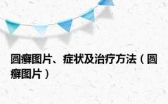 圆癣图片、症状及治疗方法（圆癣图片）